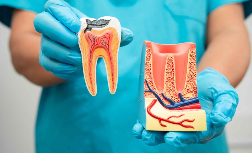 What Affects Molar Root Canal Price Dubai In Clinics?